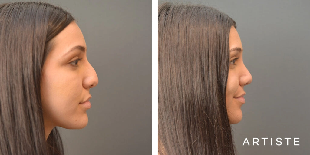 25 Year Old Shape (Dorsal Reduction) Rhinoplasty