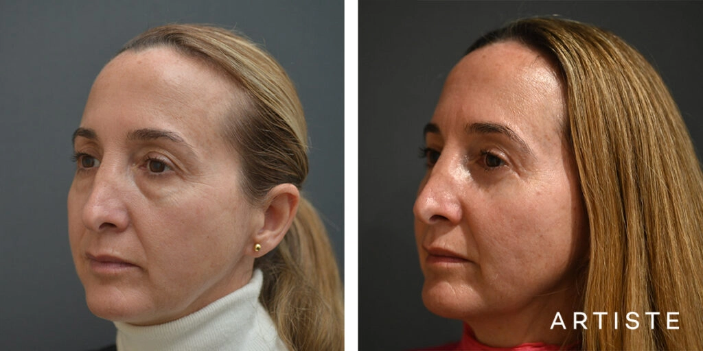 48 Year Old Lower Upper and Lower Blepharoplasty