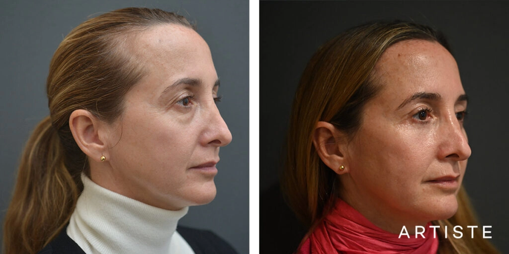 48 Year Old Lower Upper and Lower Blepharoplasty