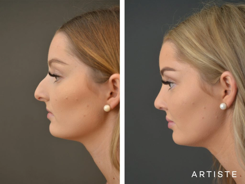 19 Year Old Profile Nose Rhinoplasty