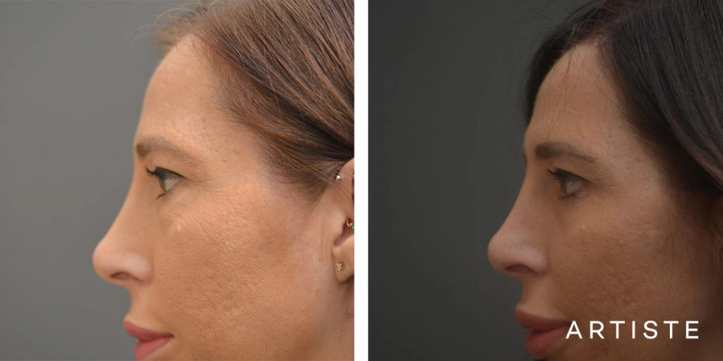36 Years Old Female Bright Eyes Lower Eyelid Blepharoplasty