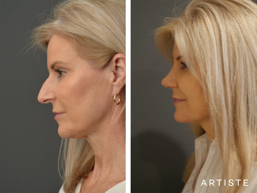 55 Years Old Female Total Nose Rhinoplasty
