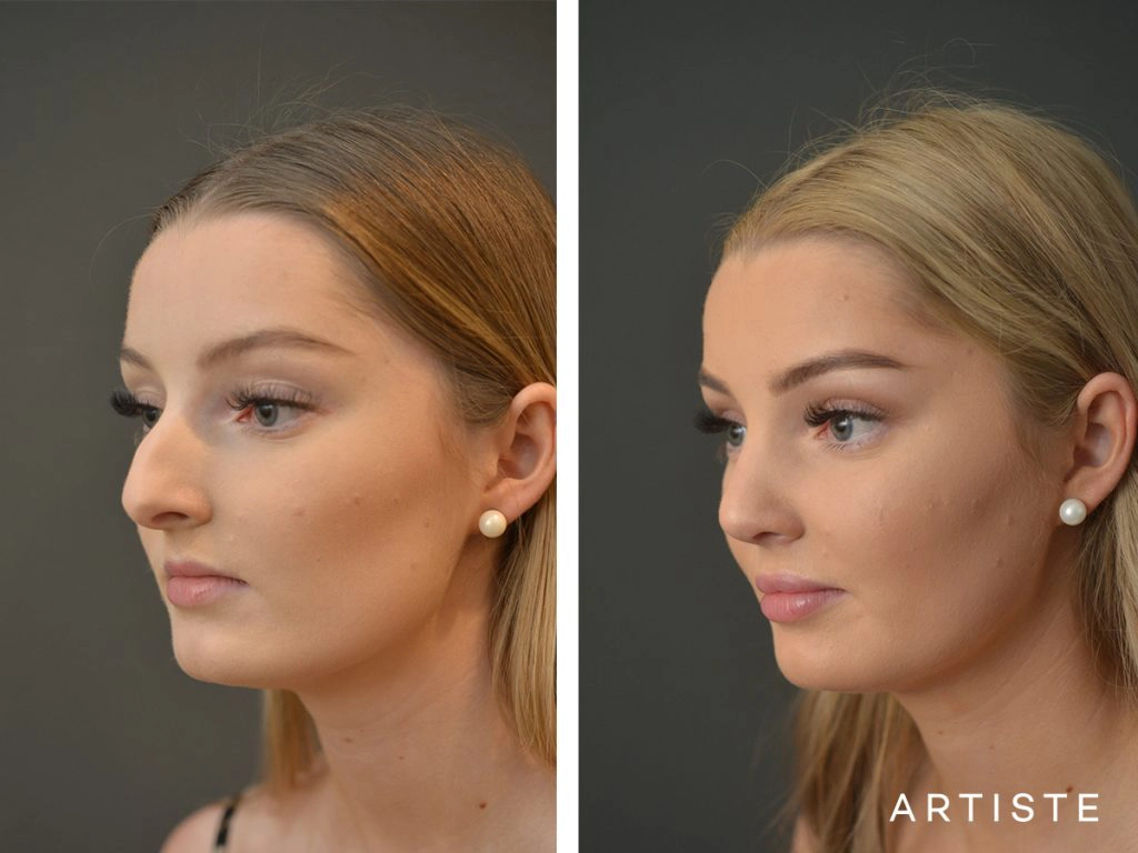 19 Year Old Profile Nose Rhinoplasty