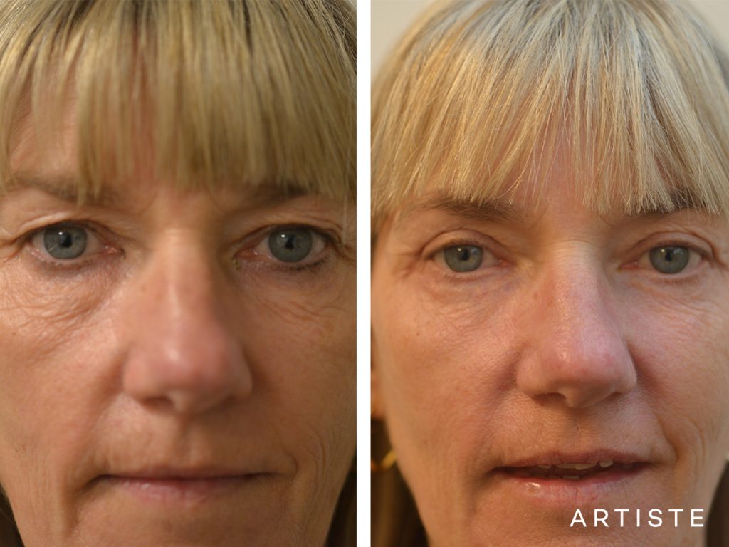 46 Years Old Female Upper + Lower Blepharoplasty by Artiste Plastic Surgery