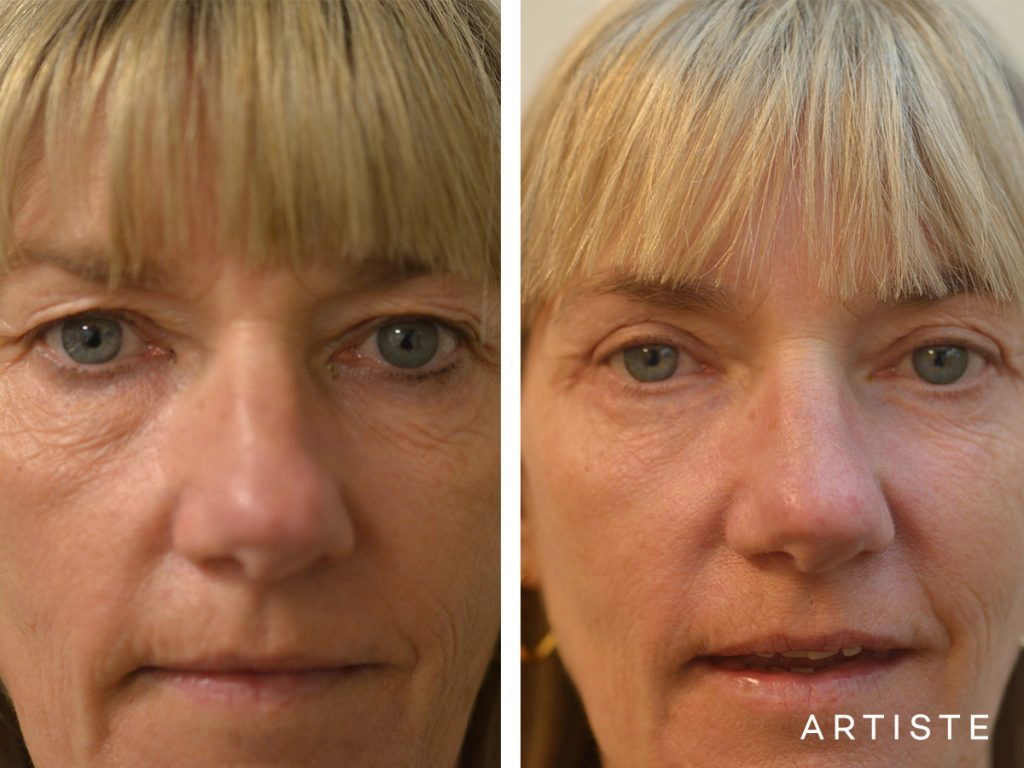 46 Years Old Female Upper + Lower Blepharoplasty