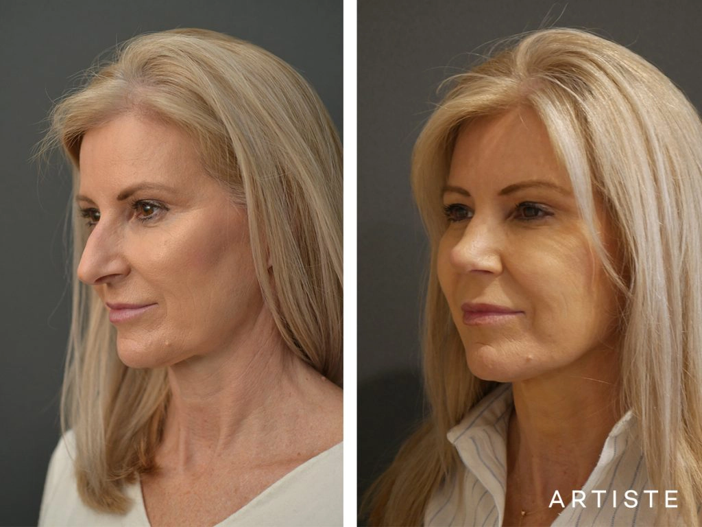 55 Years Old Female Total Nose Rhinoplasty