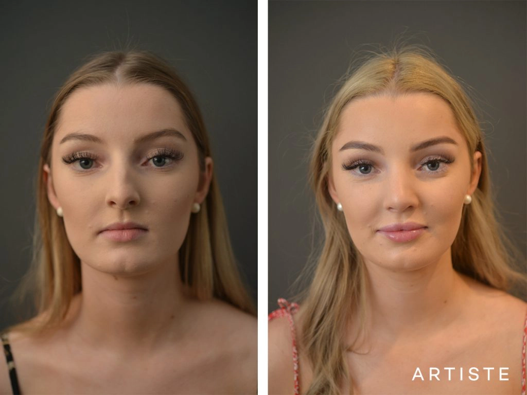 19 Year Old Profile Nose Rhinoplasty