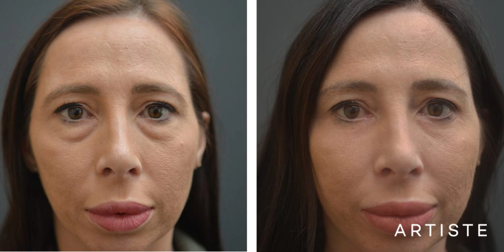 36 Years Old Female Bright Eyes Lower Eyelid Blepharoplasty