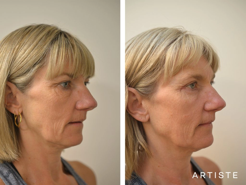 46 Years Old Female Upper + Lower Blepharoplasty