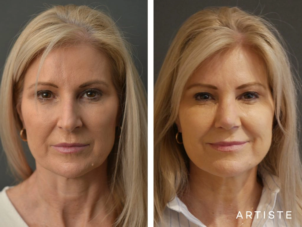 55 Years Old Female Total Nose Rhinoplasty