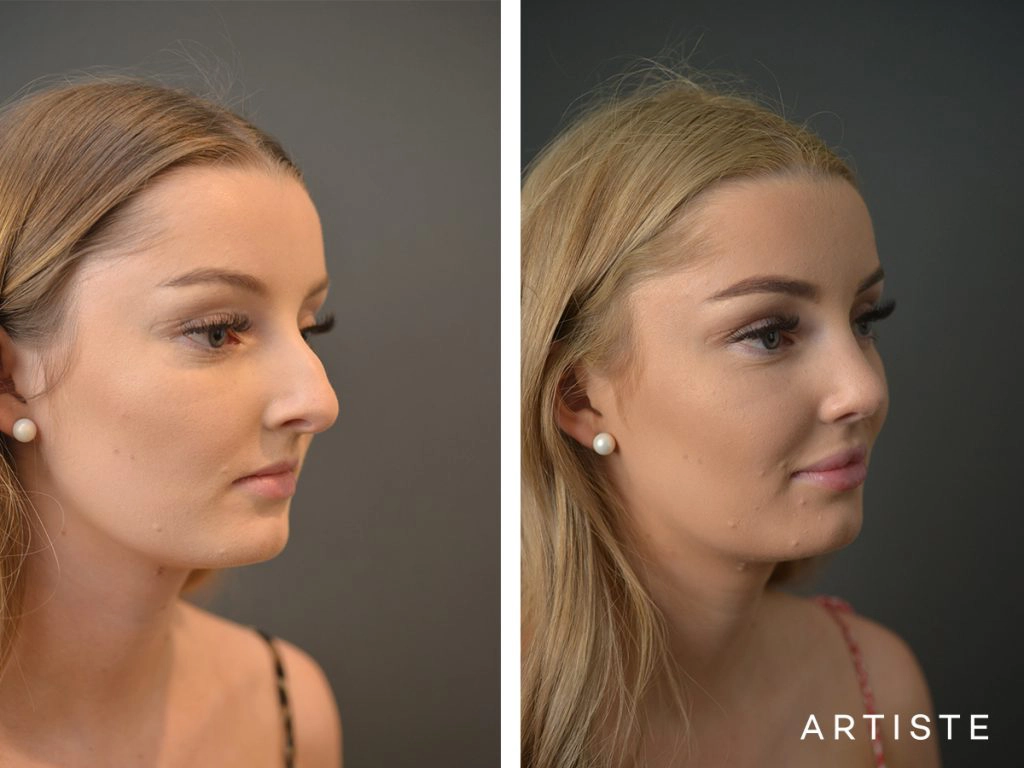 19 Year Old Profile Nose Rhinoplasty