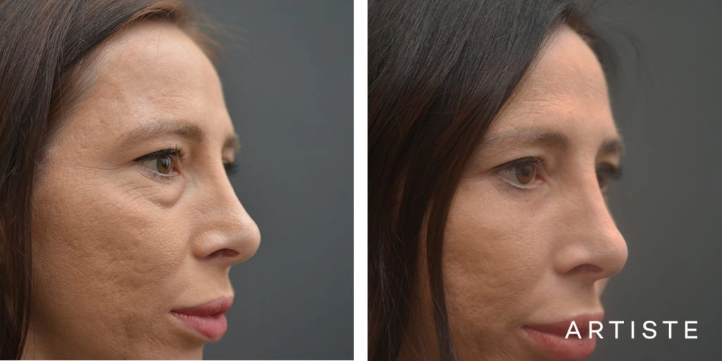 36 Years Old Female Bright Eyes Lower Eyelid Blepharoplasty