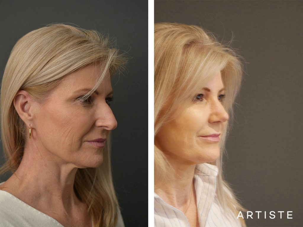 55 Years Old Female Total Nose Rhinoplasty