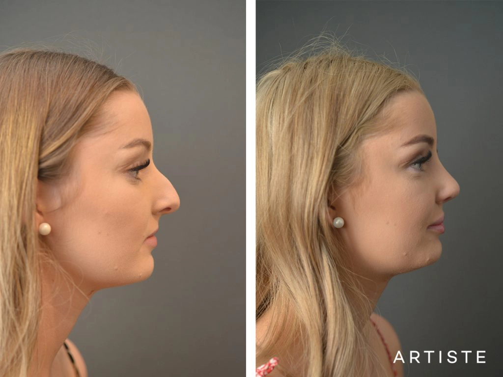 19 Year Old Profile Nose Rhinoplasty