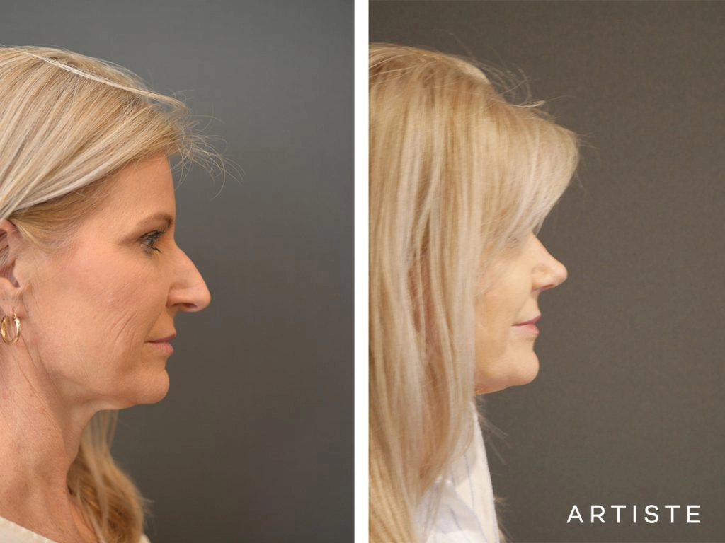 55 Years Old Female Total Nose Rhinoplasty