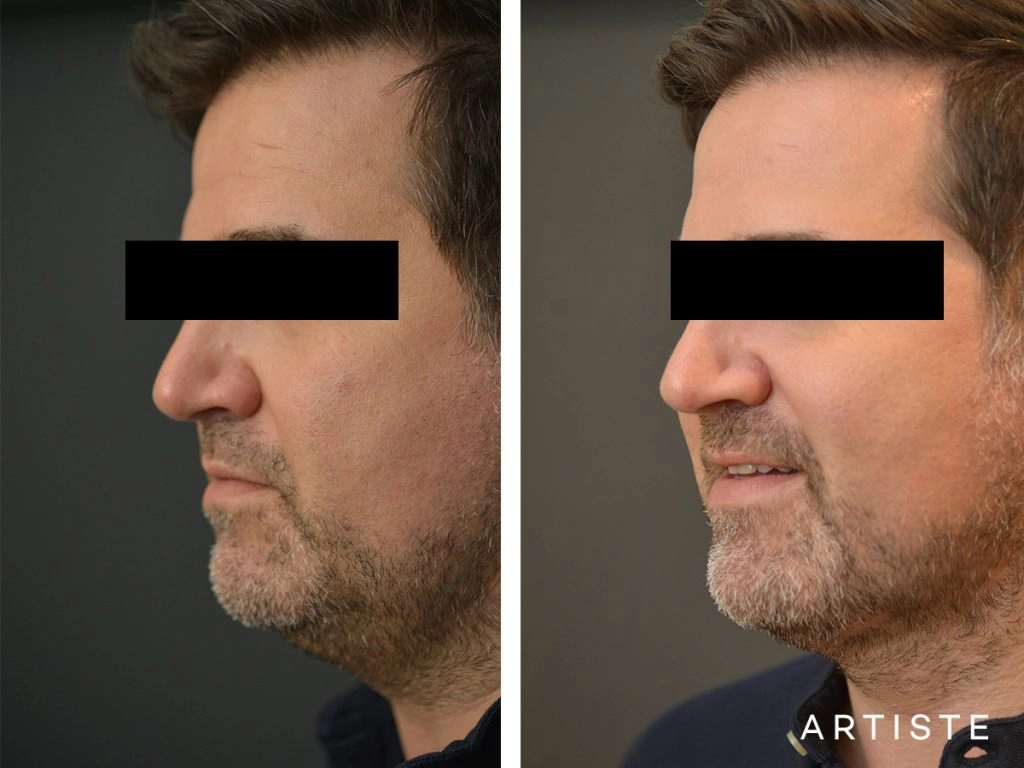 44 Year Old Liposuction and Upper Eyelids