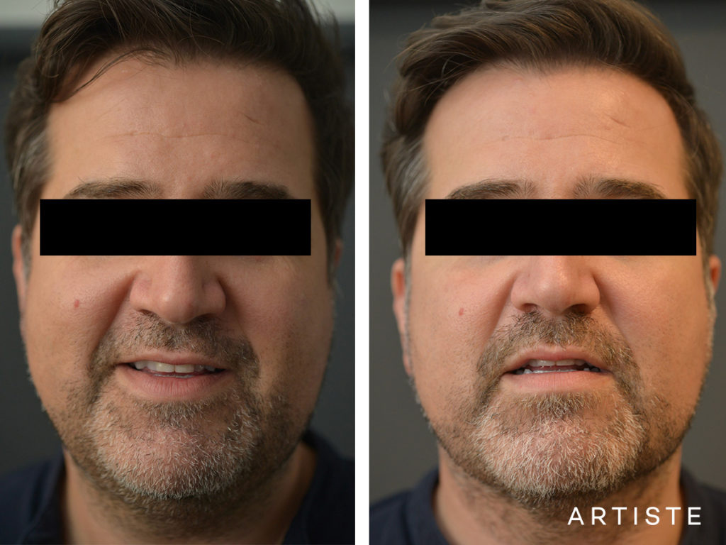 44 Year Old Liposuction and Upper Eyelids