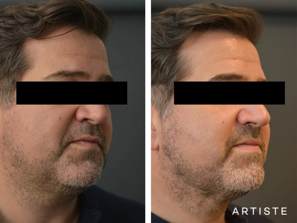 44 Year Old Liposuction and Upper Eyelids