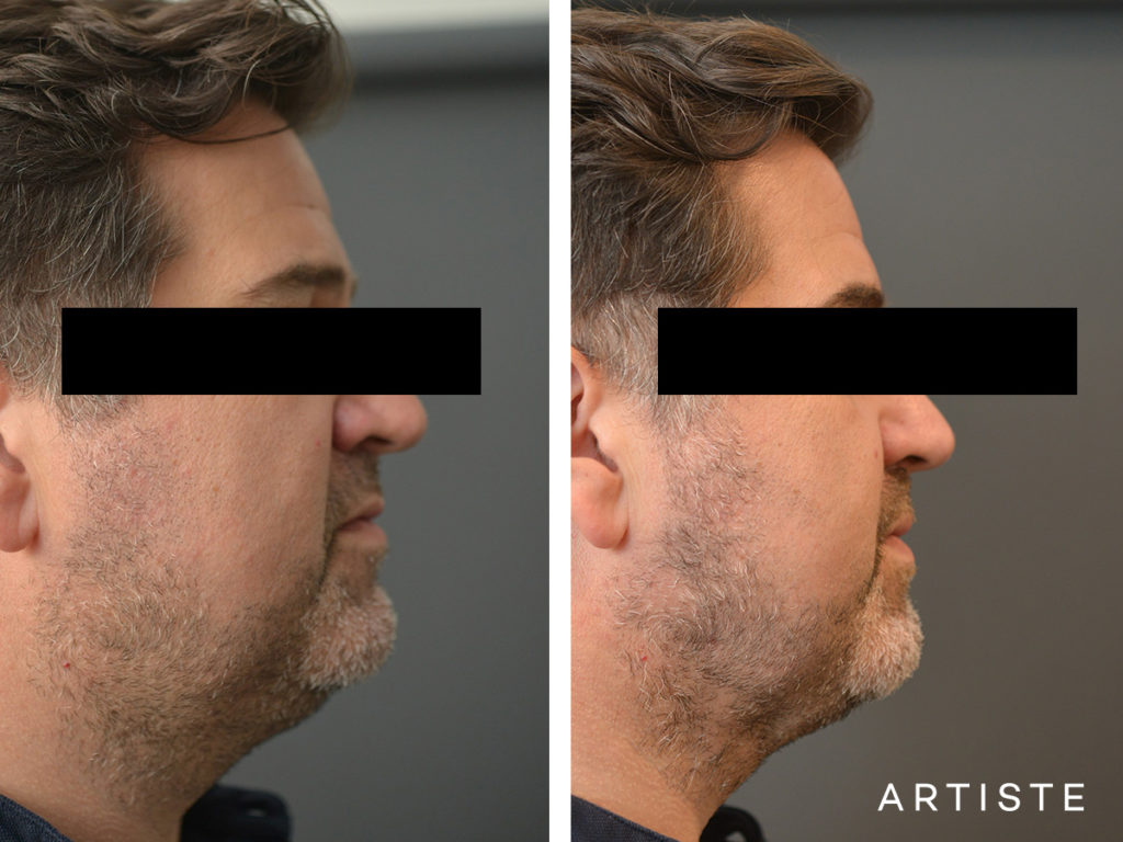 44 Year Old Liposuction and Upper Eyelids