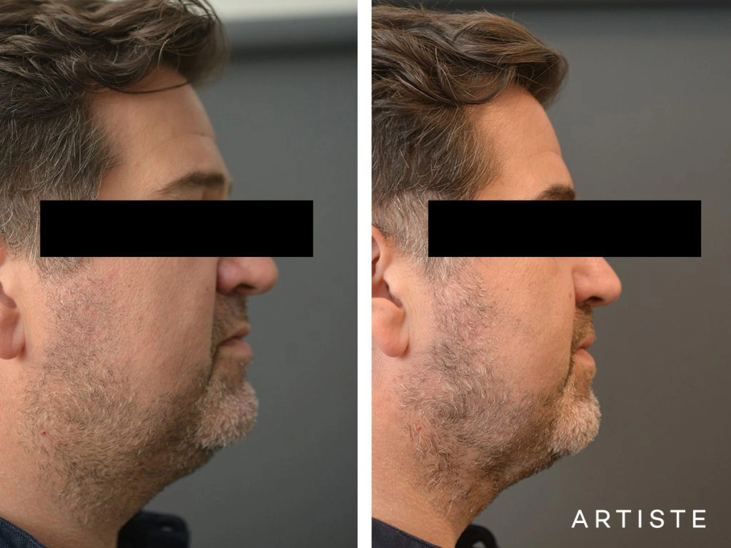 44 Year Old Liposuction and Upper Eyelids