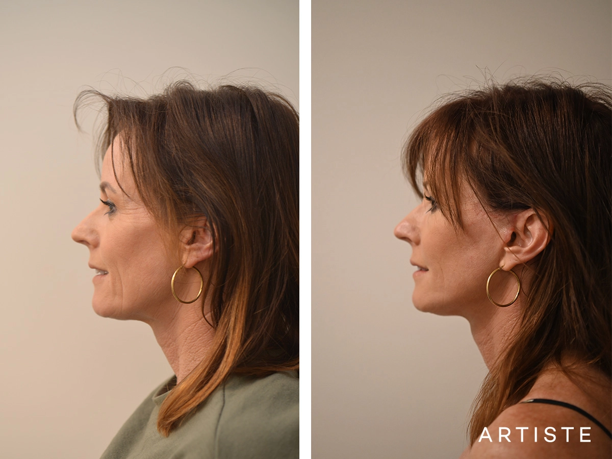 47-Year Old Artiste Signature Face Lift Patient