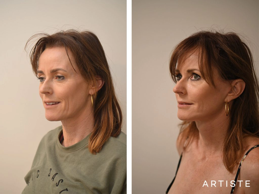 47 Year Old: Deep Plane Facelift, Temporal Brow Lift, Structural Fat Grafting, Peri-Oral Dermabrasion, Chemical Peel