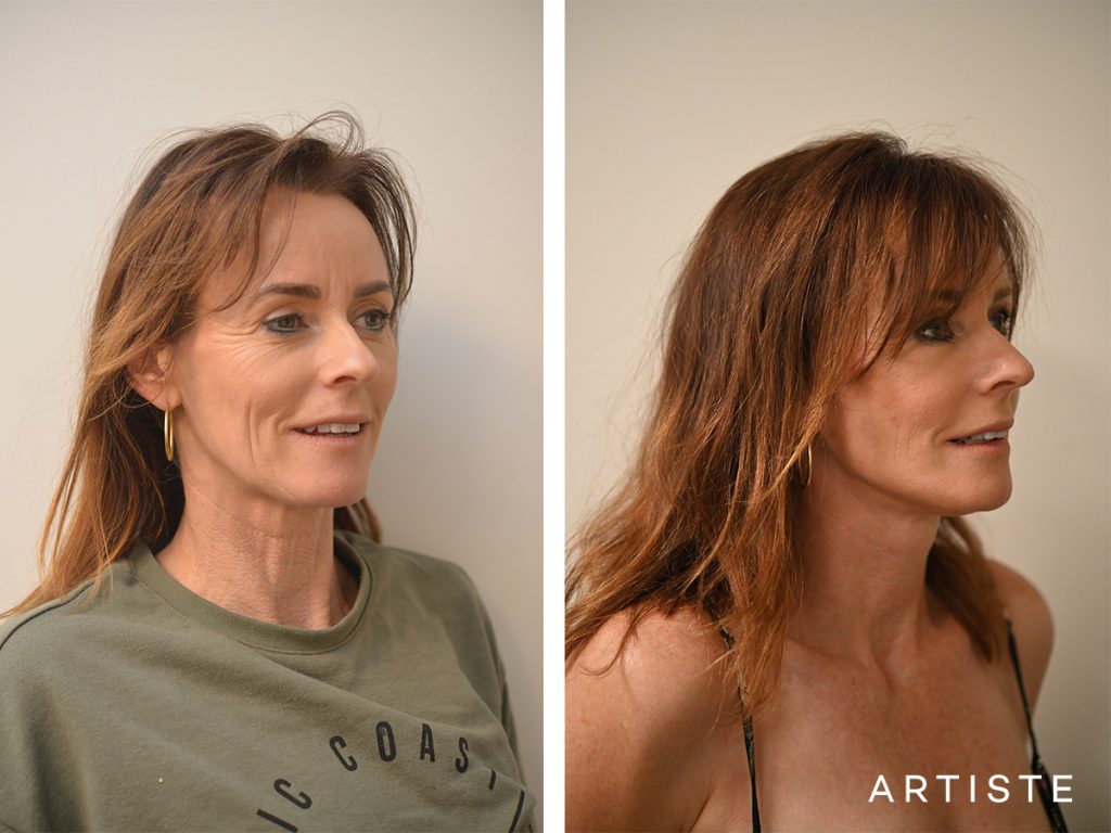 47 Year Old Signature Lift Face Brow and Eyes