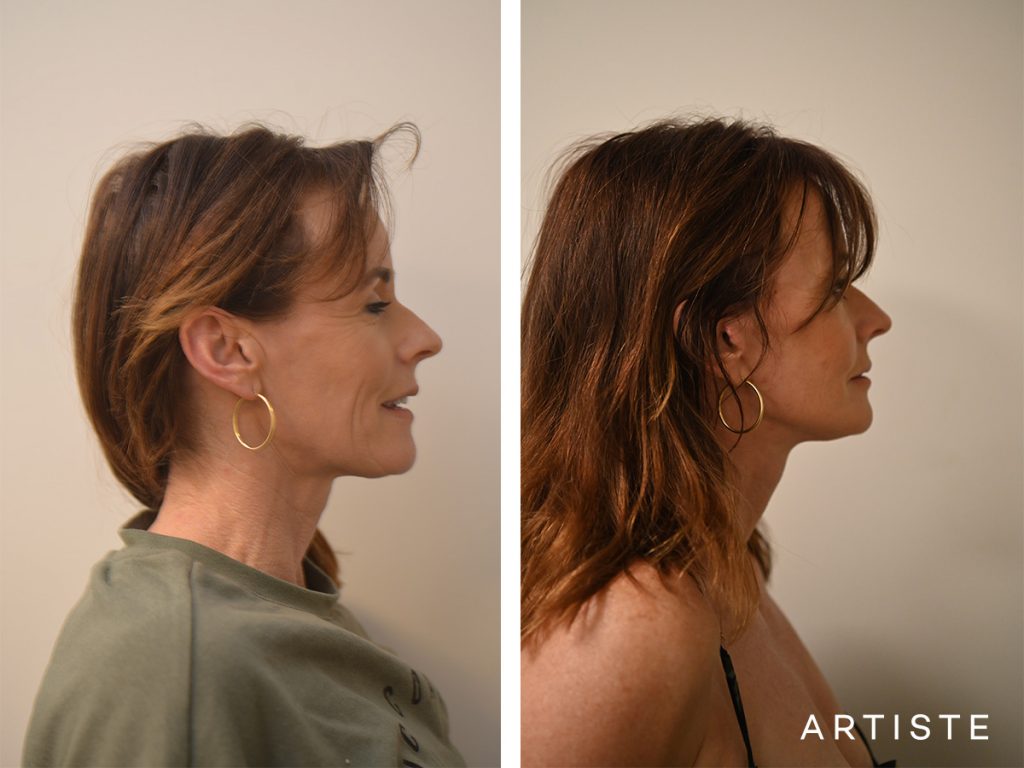 47 Year Old Signature Lift Face, Brow and Eyes