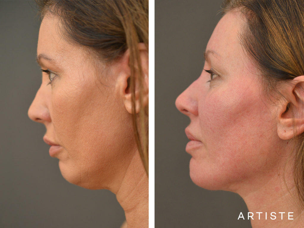 47 Year Old Neck Liposuction