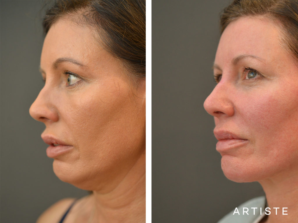 47 Year Old Neck Liposuction