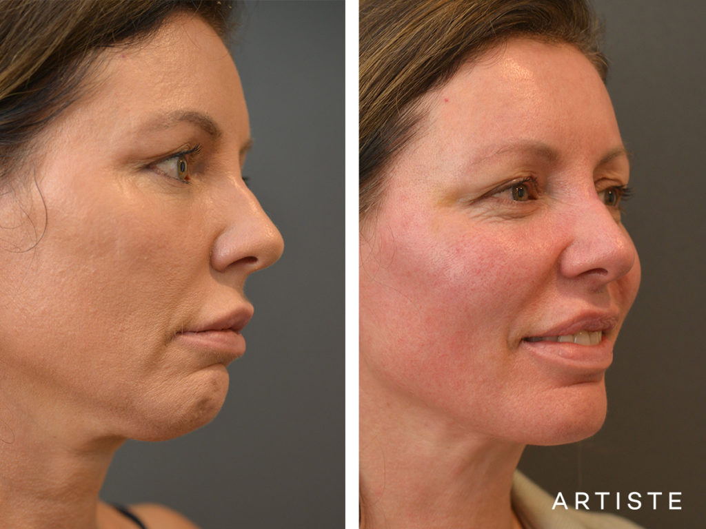 47 Year Old Neck Liposuction