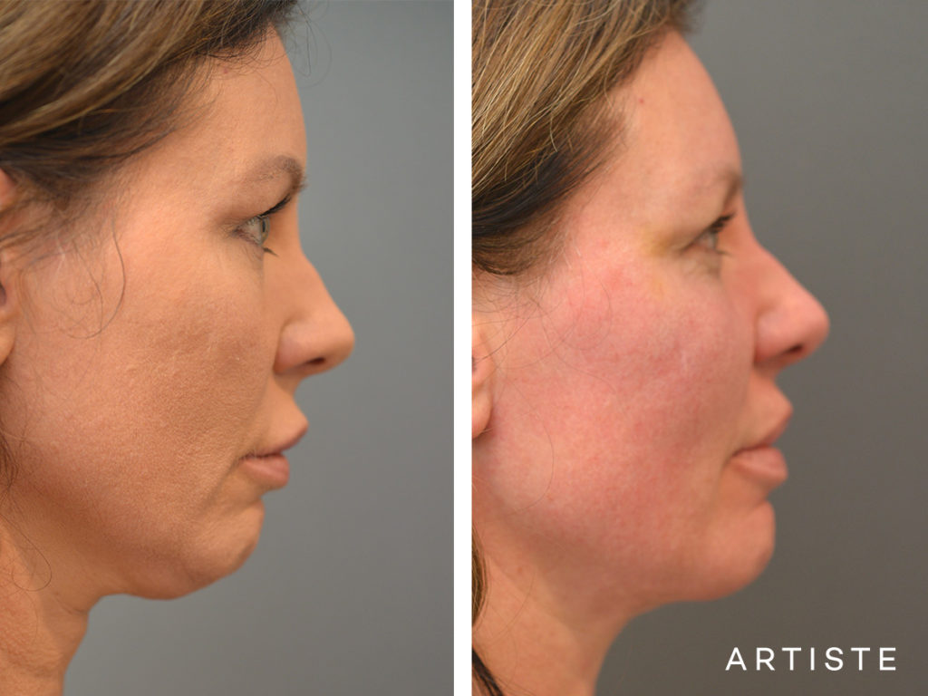 47 Year Old Neck Liposuction