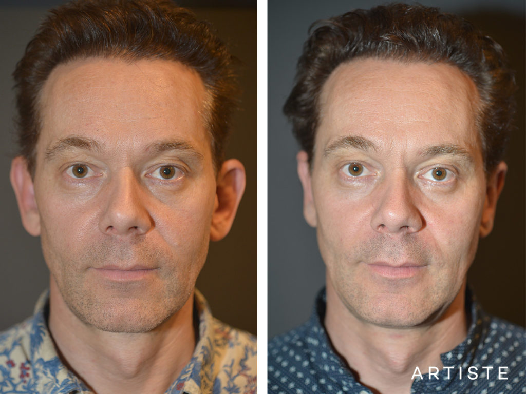 before and after image of a man who has undergone otoplasty surgery in sydney from dr jack zoumaras