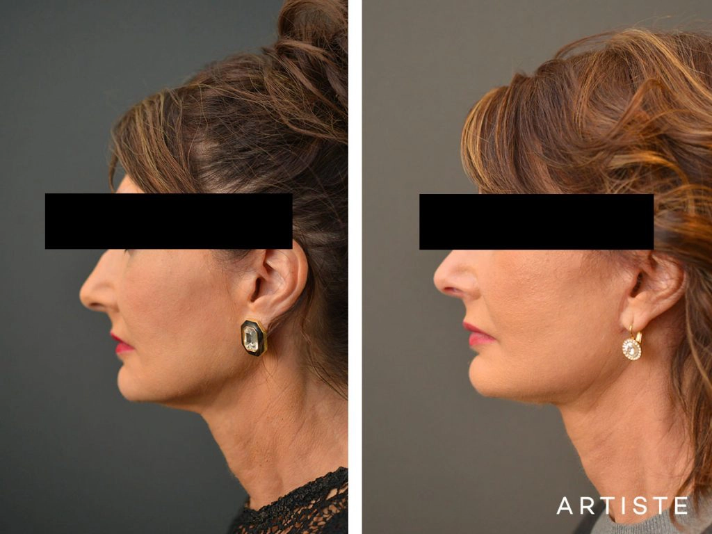57 Year Old Ultimate Neck Lift