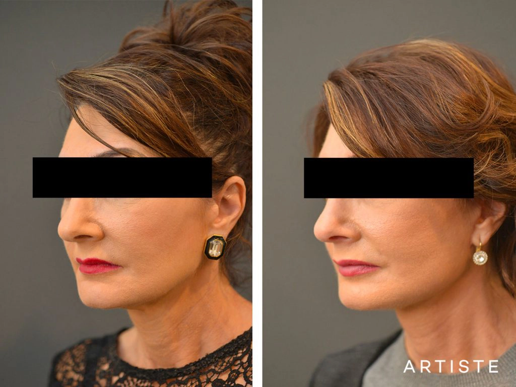 57 Year Old Ultimate Neck Lift