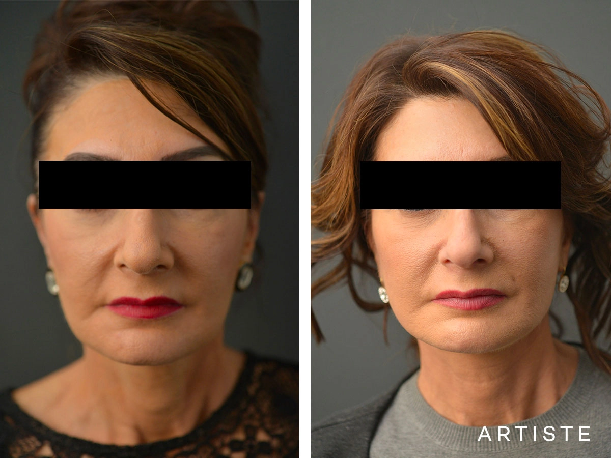 Neck Lift before and After Photo