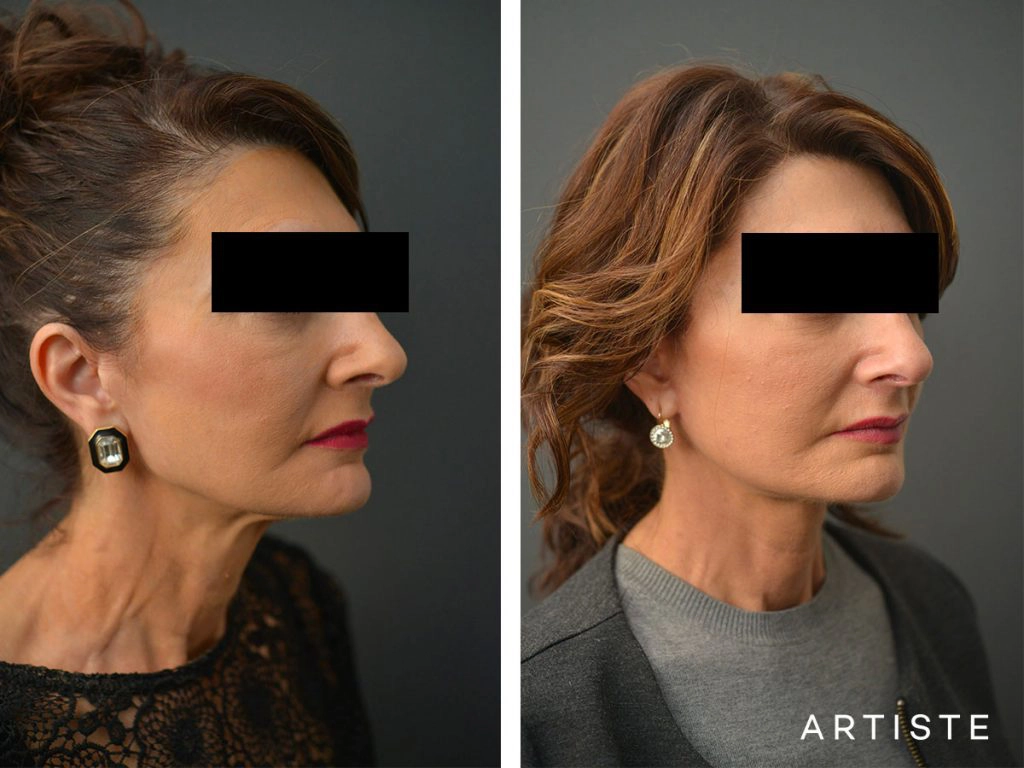 57 Year Old Ultimate Neck Lift