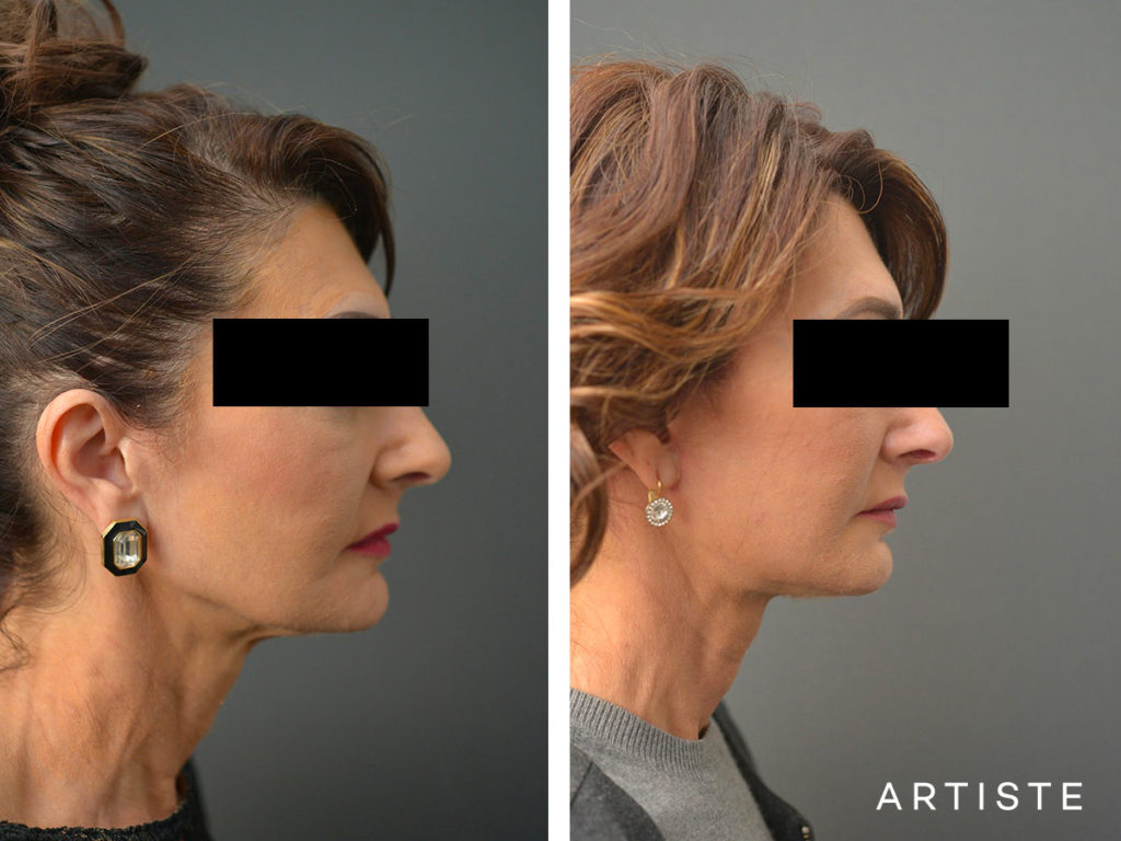 57 Year Old Ultimate Neck Lift