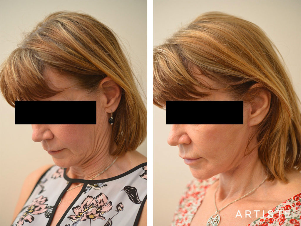 60 Year Old Ultimate Neck Lift