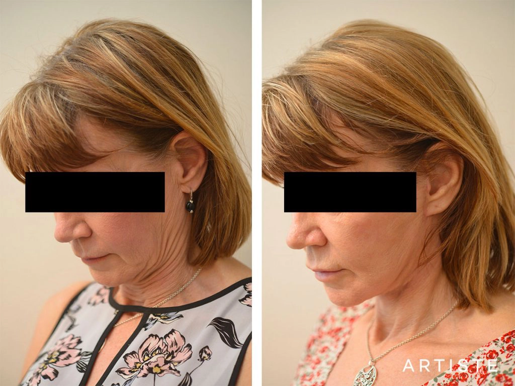 60 Year Old Ultimate Neck Lift