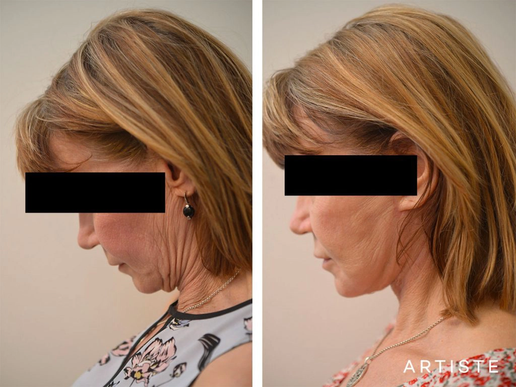 60 Year Old Ultimate Neck Lift