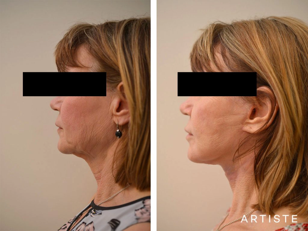 60 Year Old Ultimate Neck Lift