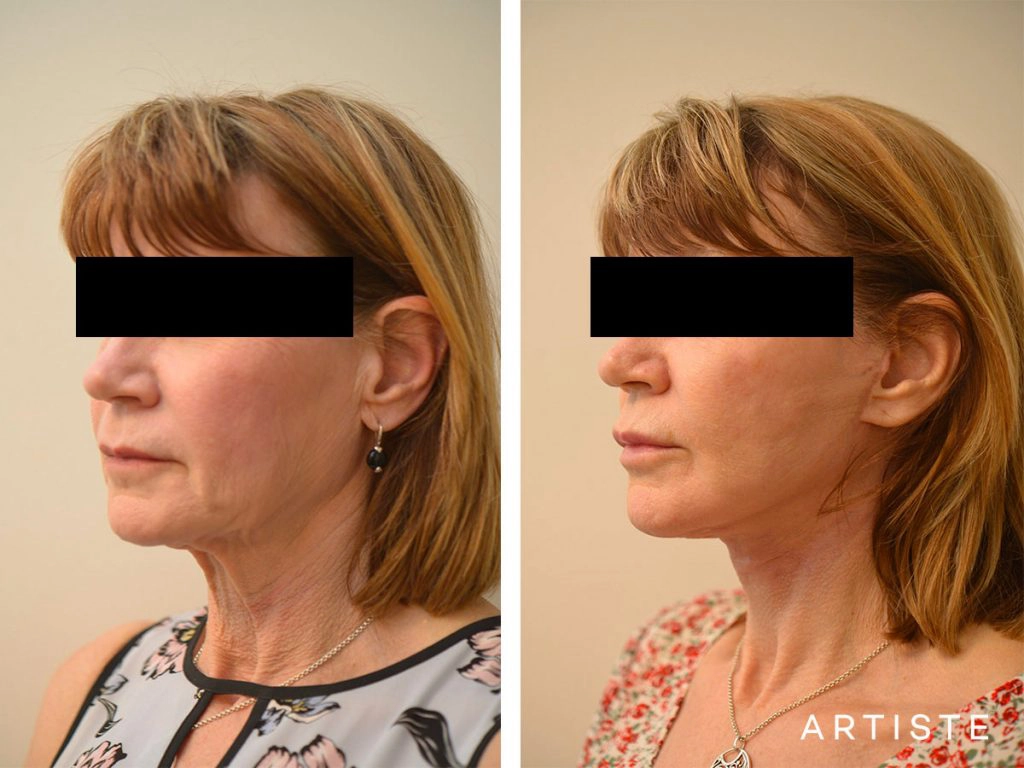 60 Year Old Ultimate Neck Lift