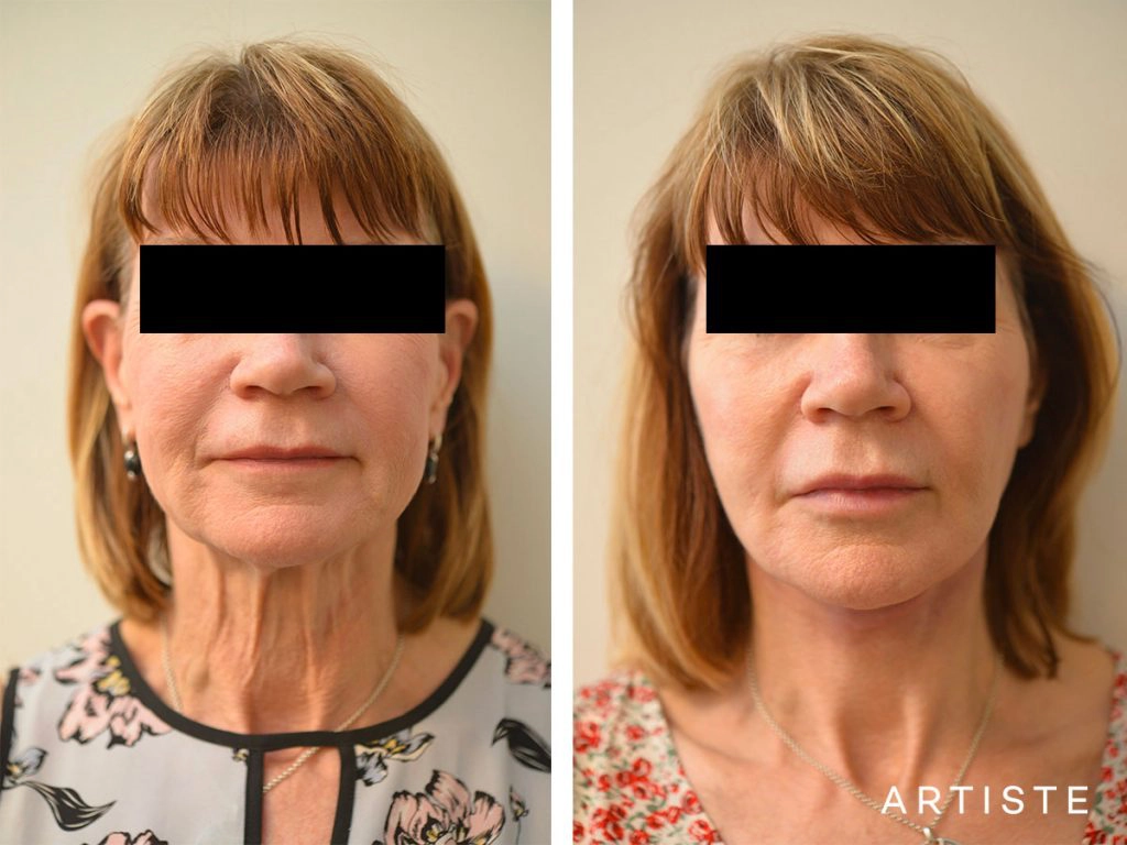 60 Year Old Ultimate Neck Lift