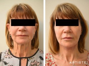 60 Years Old Neck Lift