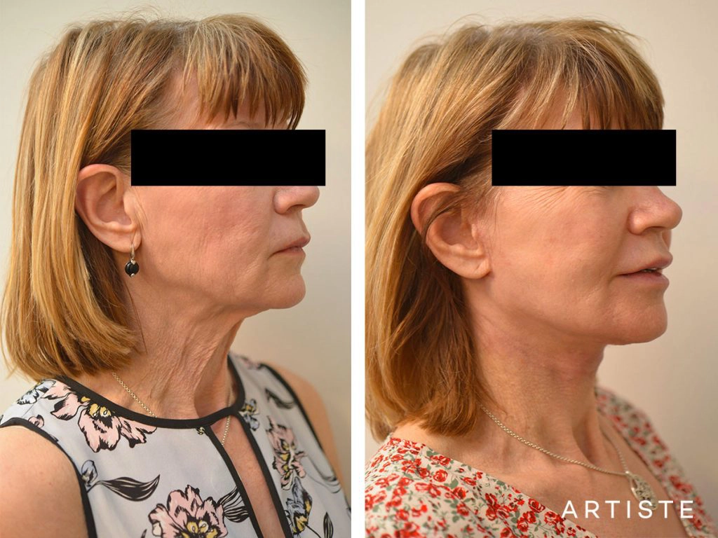 60 Year Old Ultimate Neck Lift