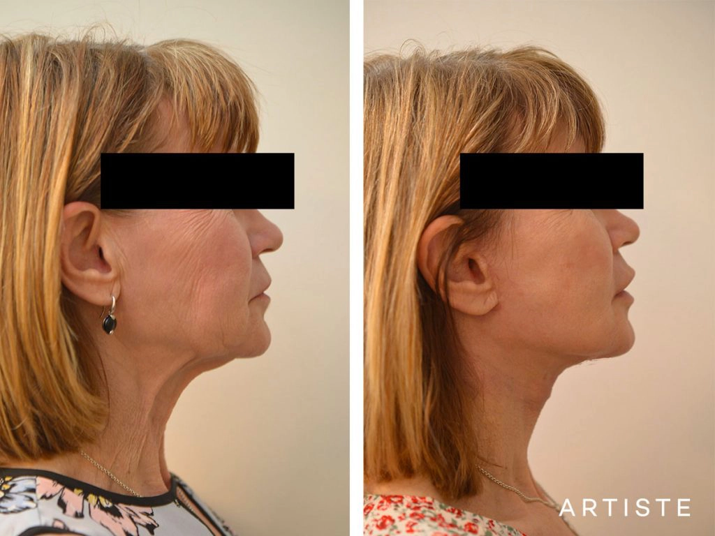 60 Year Old Ultimate Neck Lift