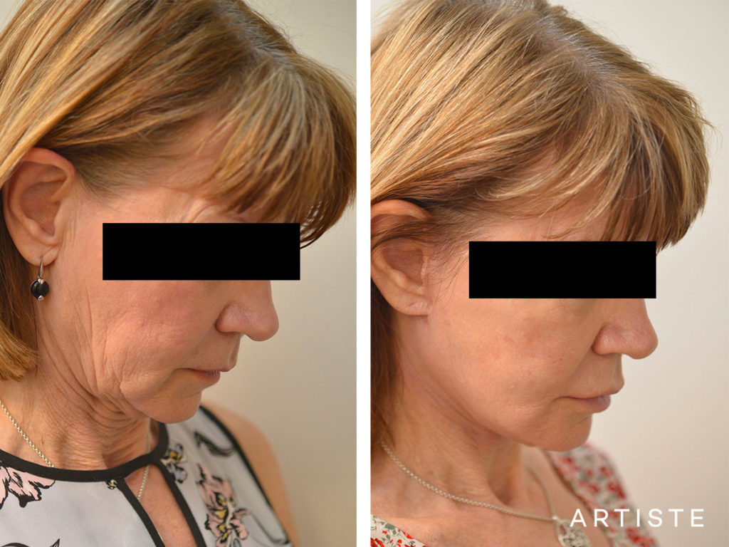 60 Year Old Ultimate Neck Lift