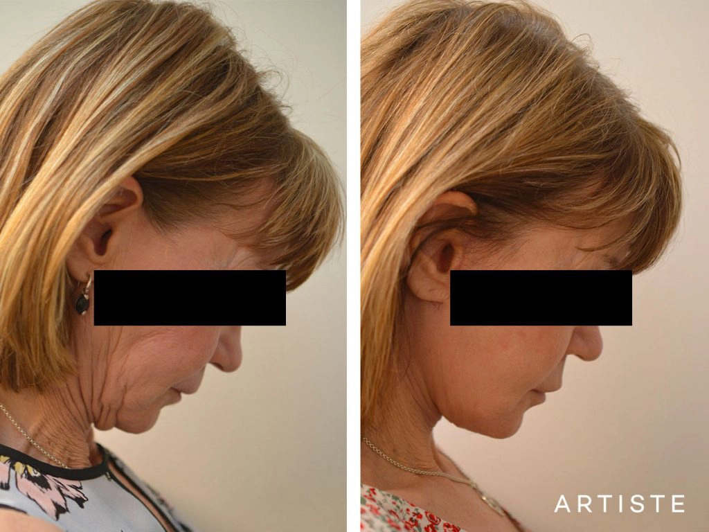 60 Year Old Ultimate Neck Lift