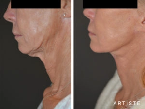 61 Years Old Necklift